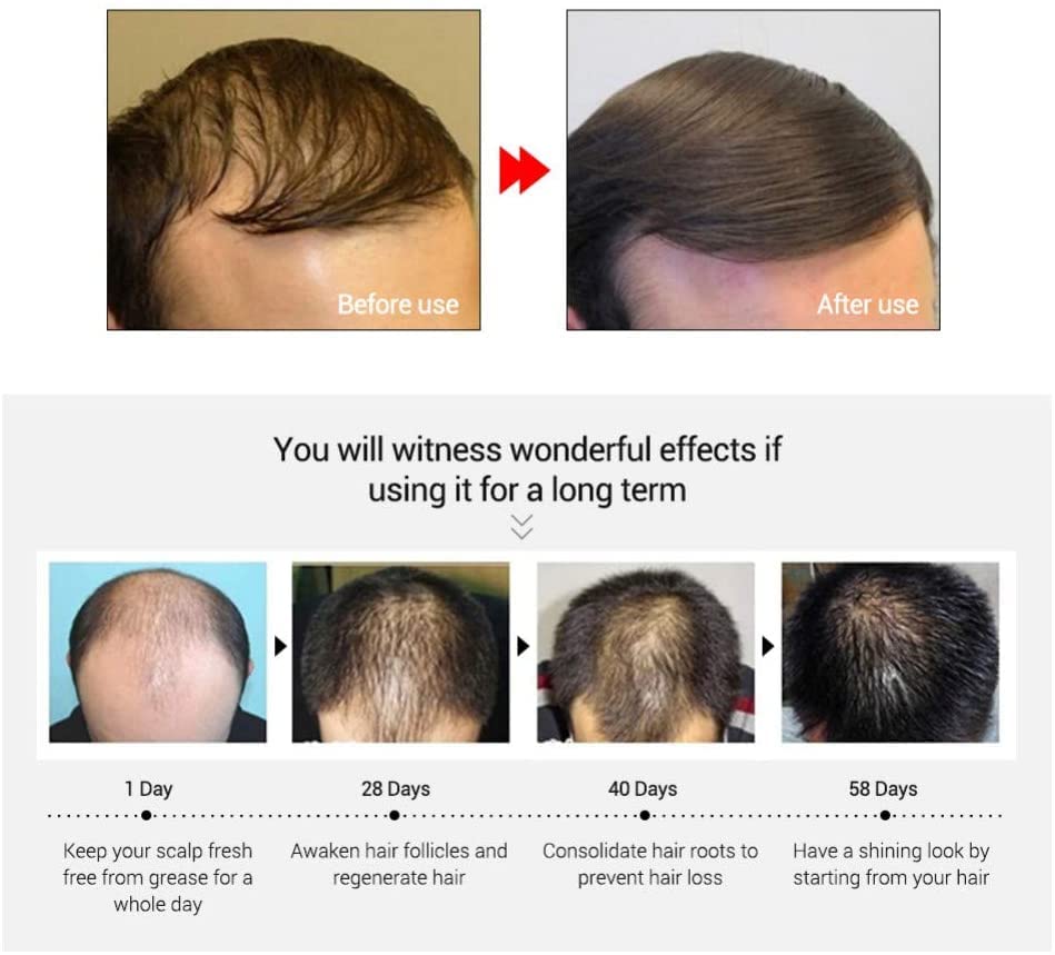 MKKENLEY Natural Ginseng Hair Growth Tonic